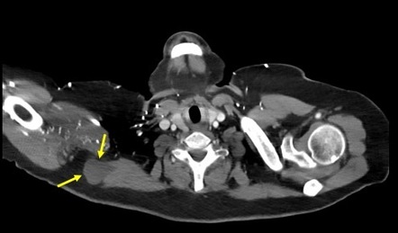 yellowstone pathology