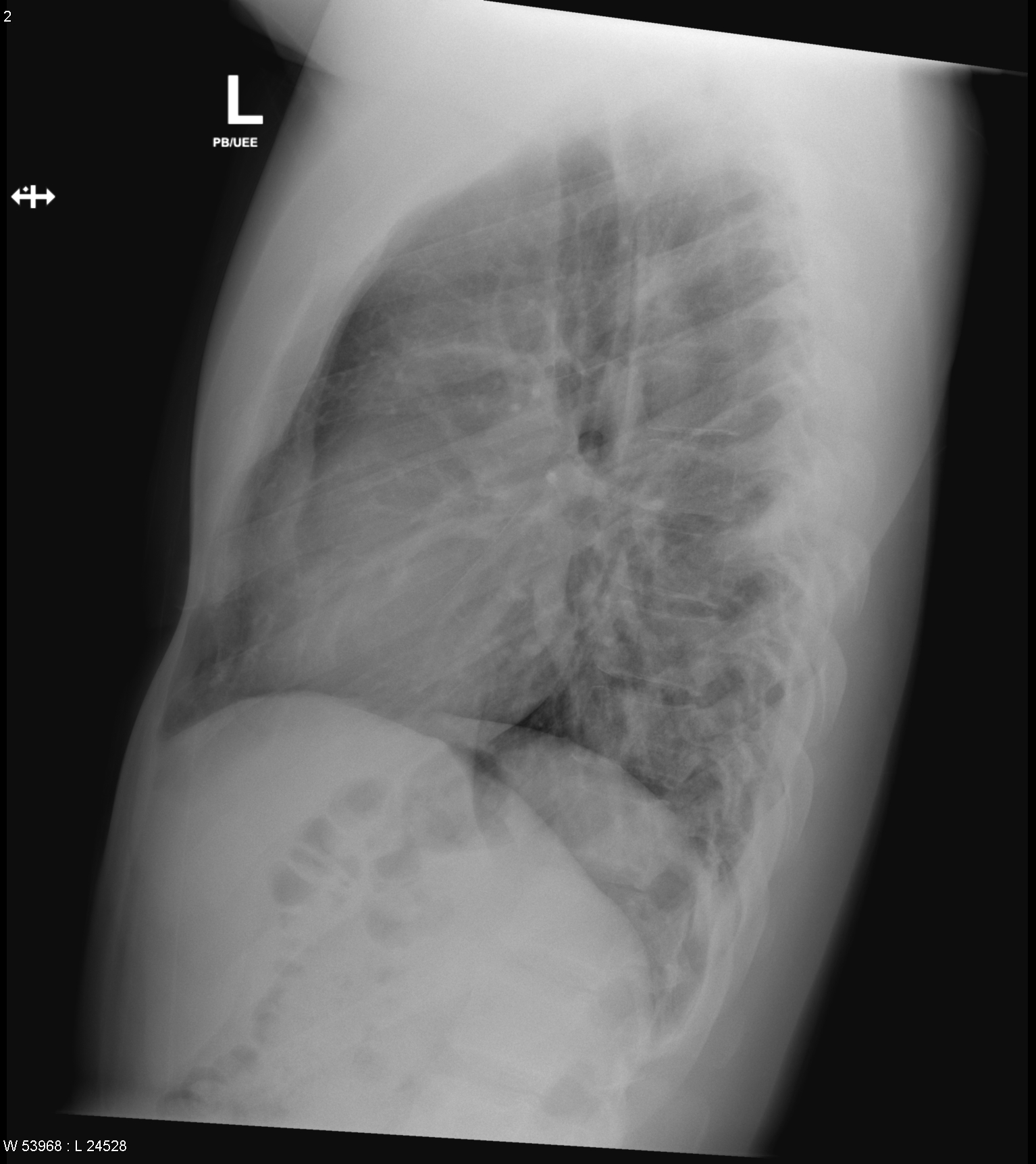 Omovertebral bone with Sprengel shoulder | Image | Radiopaedia.org