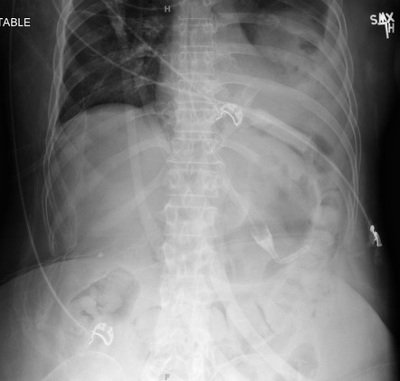 Esophageal cooling device | Radiology Case | Radiopaedia.org