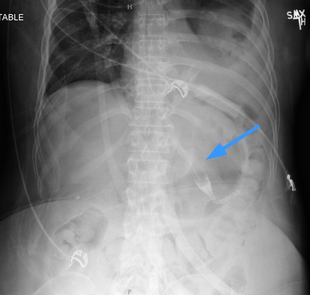 Esophageal cooling device | Image | Radiopaedia.org