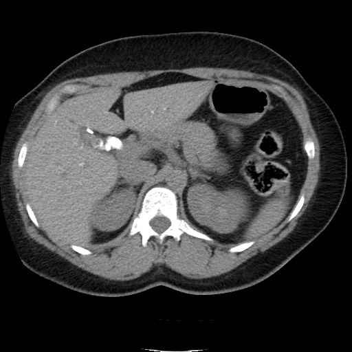 Cholangiogram Procedure