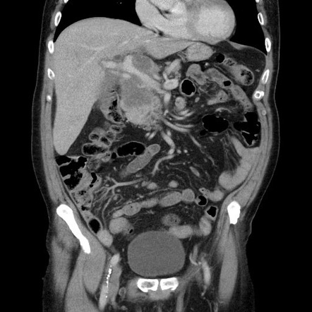 Pancreatic adenocarcinoma - uncinate process | Image | Radiopaedia.org