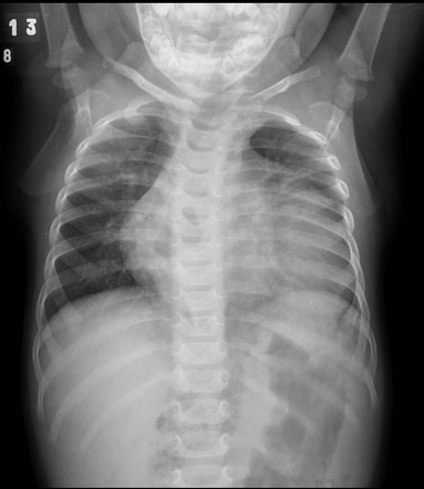 Morgagni hernia | Radiology Case | Radiopaedia.org