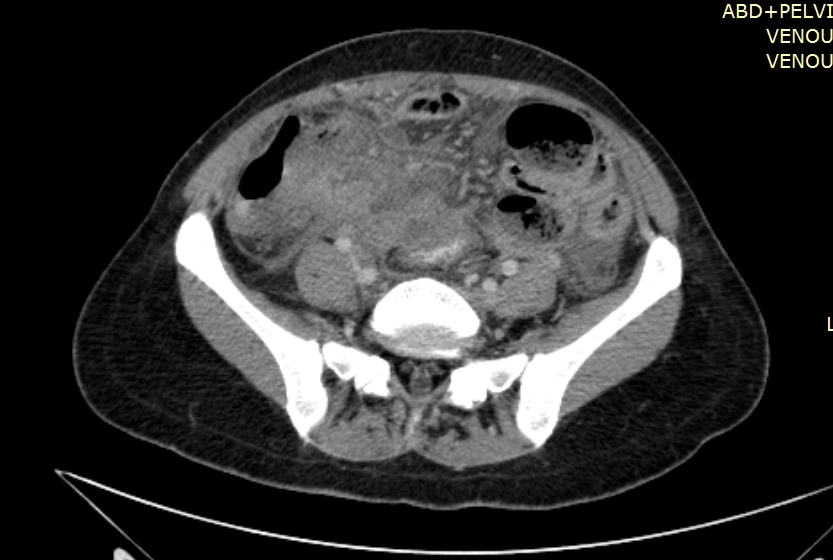 Appendicular Abscess | Image | Radiopaedia.org