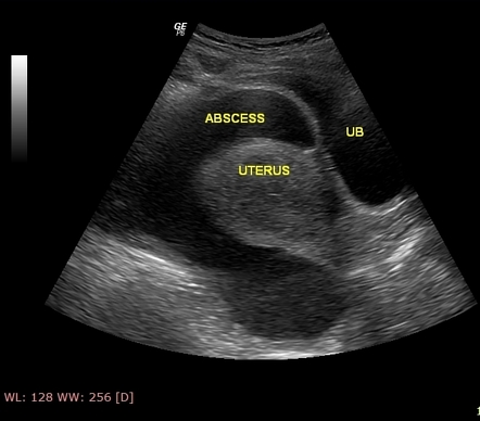 Appendicular Abscess | Radiology Case | Radiopaedia.org