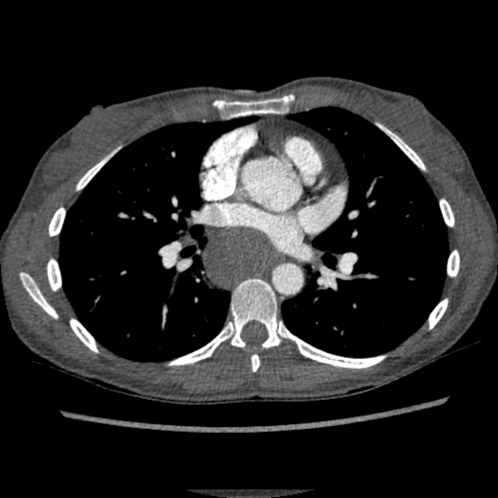 Esophageal duplication cyst | Image | Radiopaedia.org