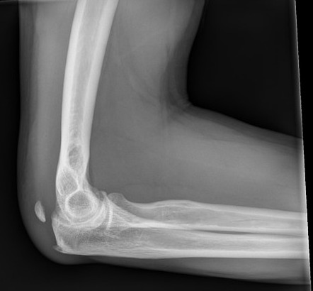 Patella cubiti | Radiology Reference Article | Radiopaedia.org