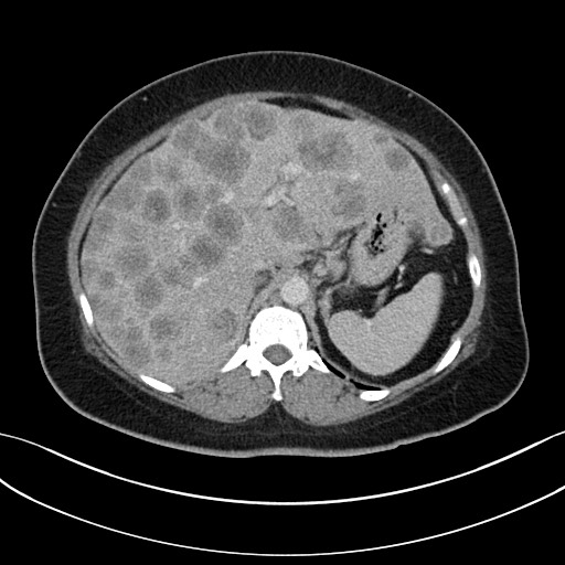 Metatstatic colorectal cancer | Image | Radiopaedia.org