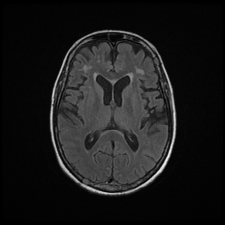 Multiple myeloma | Image | Radiopaedia.org