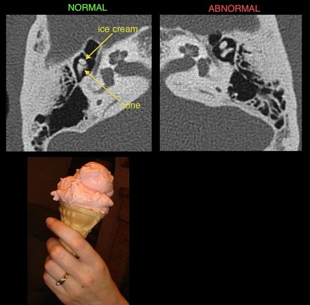 Radiopaedia - Drawing Middle ear ossicles: malleus, incus and