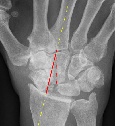 Carpal height | Radiology Reference Article | Radiopaedia.org