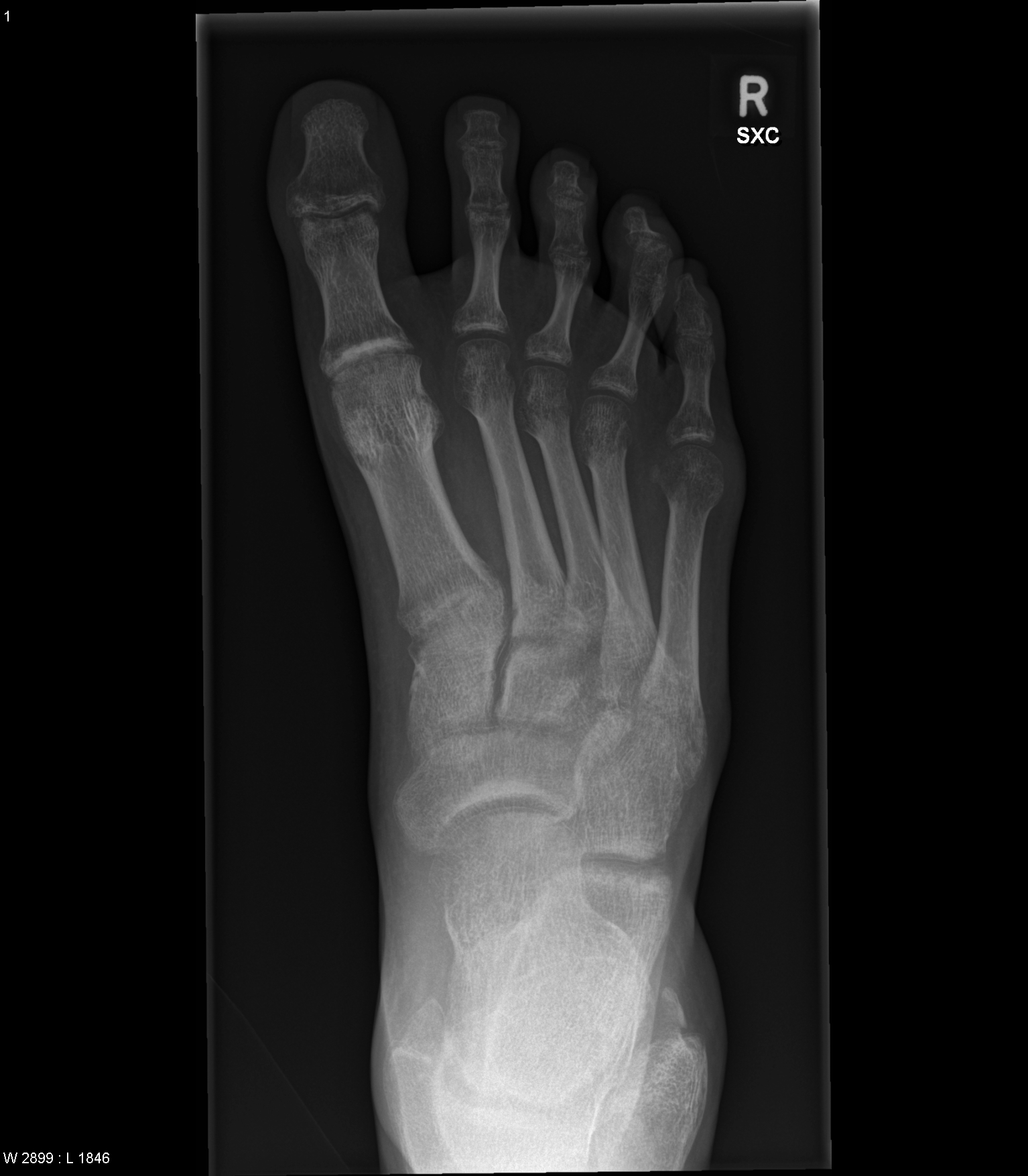 Reflex sympathetic dystrophy | Image | Radiopaedia.org