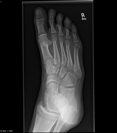 Reflex sympathetic dystrophy | Image | Radiopaedia.org