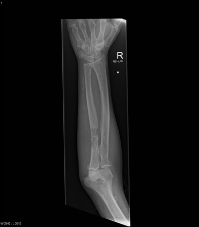 Ulnar melanoma metastasis with pathological fracture | Radiology Case ...