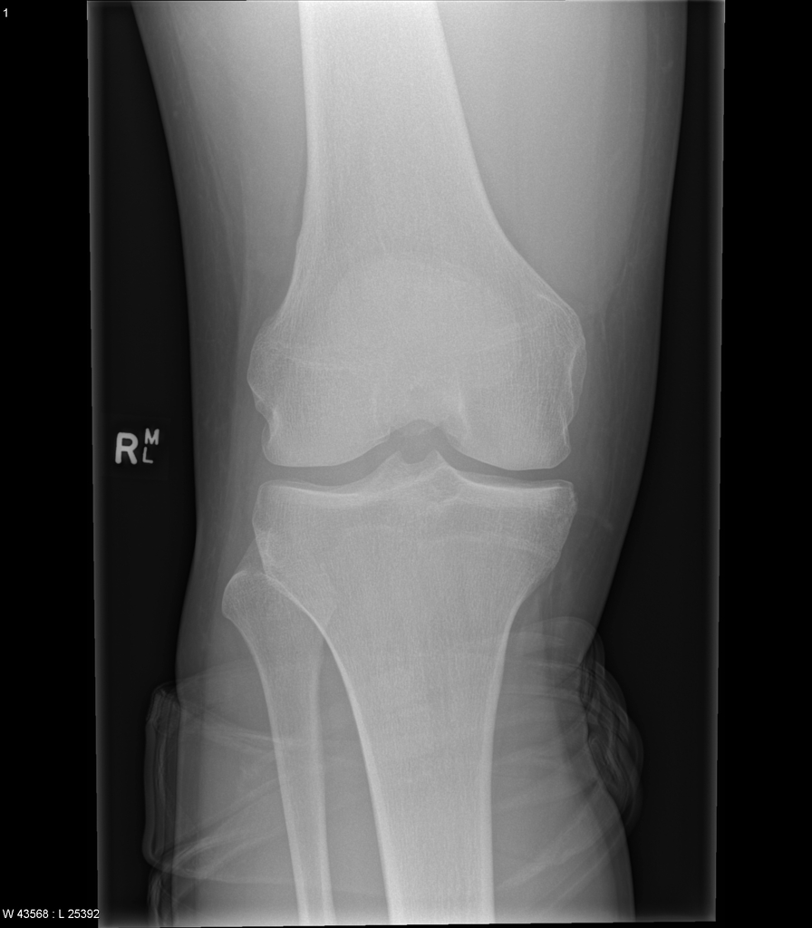 Cortical Desmoid Radiology Case Radiopaedia Org