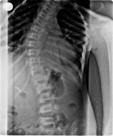 H-shaped vertebra | Image | Radiopaedia.org