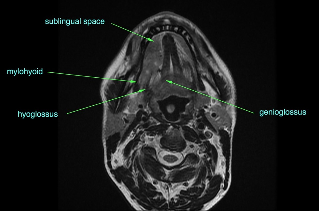 Tongue And Floor Of Mouth Neoplasm Radiology Case