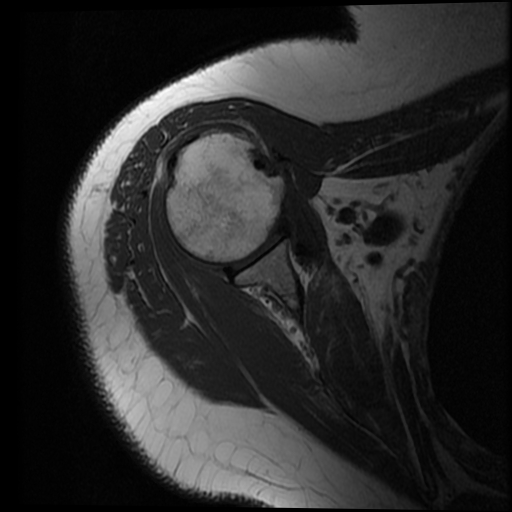 Partial supraspinatus tendon tear | Image | Radiopaedia.org