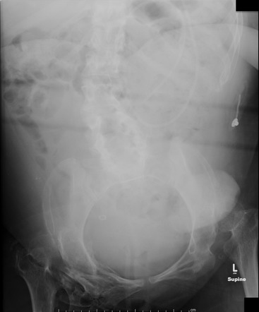 Developmental dysplasia of the hip | Radiology Reference Article ...