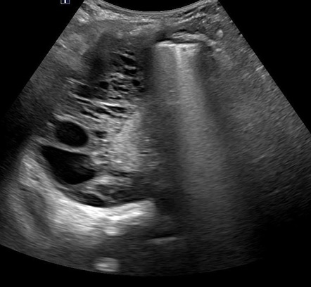 Thoracic empyema | Radiology Case | Radiopaedia.org