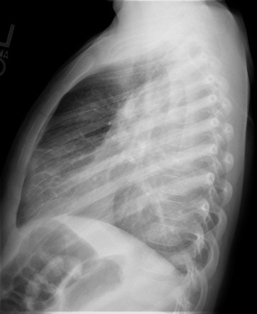 Thoracic empyema | Image | Radiopaedia.org