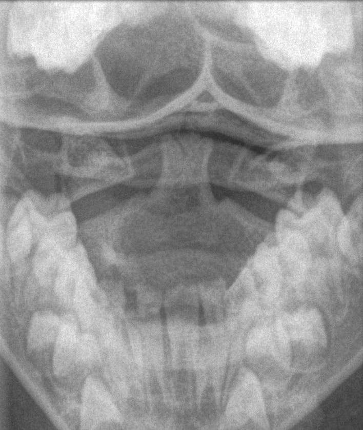 Cervical Pseudosubluxation 