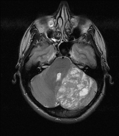 Dysplastic cerebellar gangliocytoma | Radiology Reference Article ...