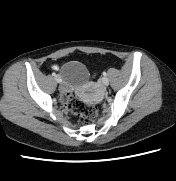 Low-grade appendiceal mucinous neoplasm | Radiology Reference Article ...