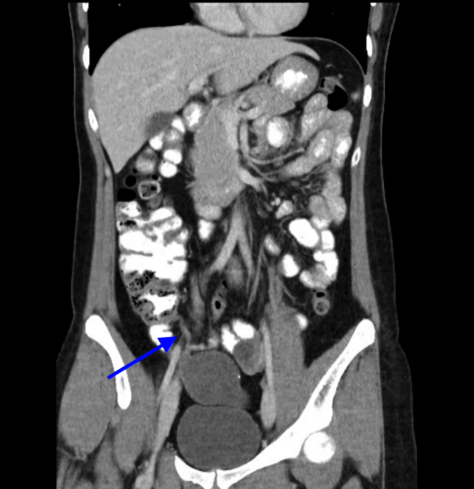 Low Grade Appendiceal Mucinous Neoplasm Image