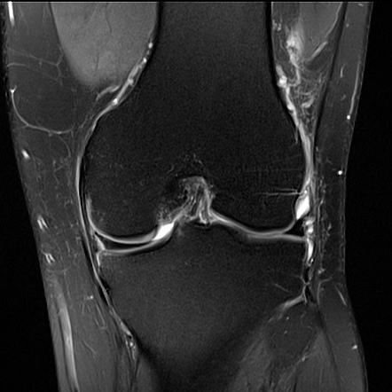 Longitudinal (vertical) meniscal tear | Radiology Case | Radiopaedia.org