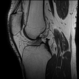 Longitudinal (vertical) meniscal tear | Image | Radiopaedia.org