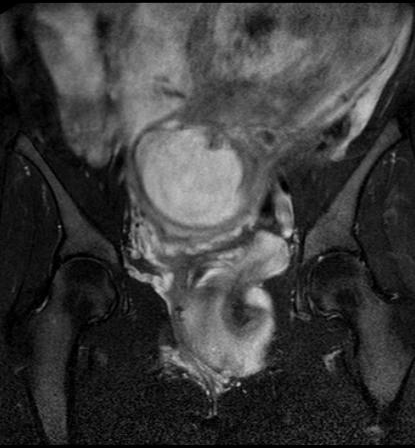 Aggressive angiomyxoma of the pelvis and perineum | Image | Radiopaedia.org