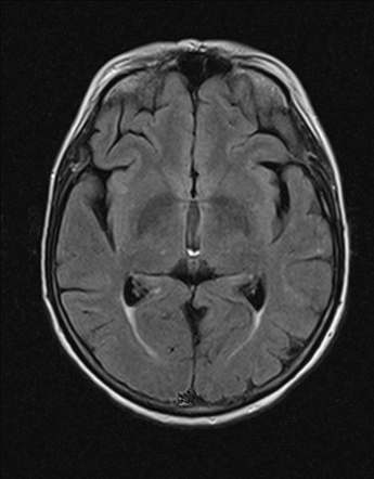 Tentorium hypoplasia with partial occipital lobe herniation | Image ...