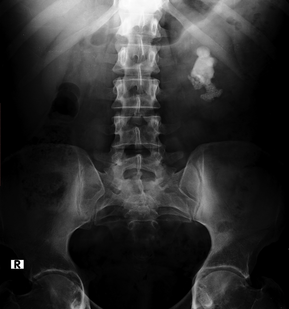 Kidney Stones Chest X Ray - KIDRIZI