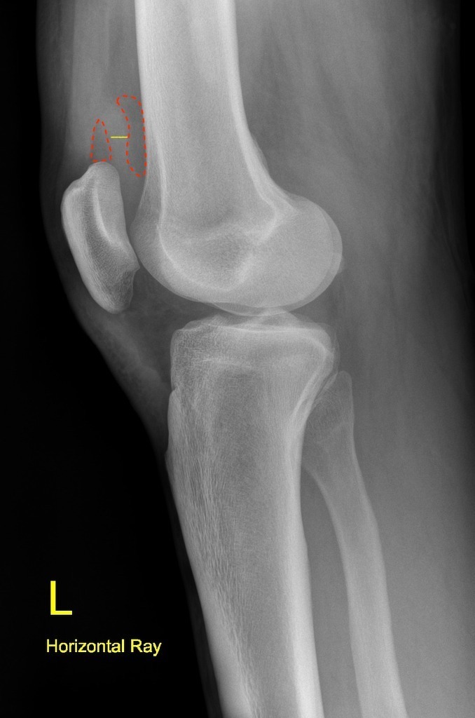 fluid in knee called