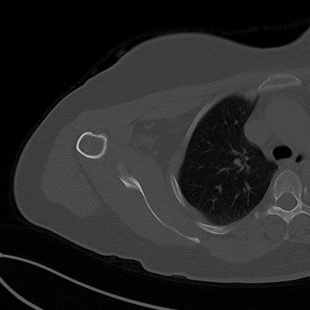 Enchondroma | Image | Radiopaedia.org