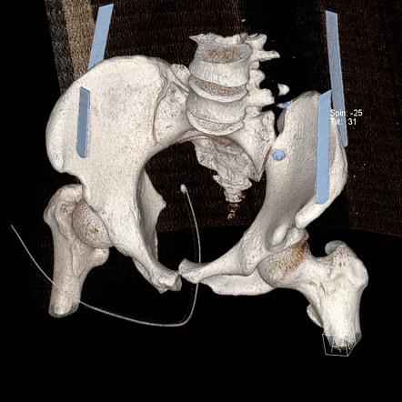 Grade 3 AP compression fracture of the pelvis