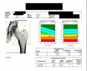 Viewing playlist: Osteoporotic Vertebral Fracture & Non-fracture ...