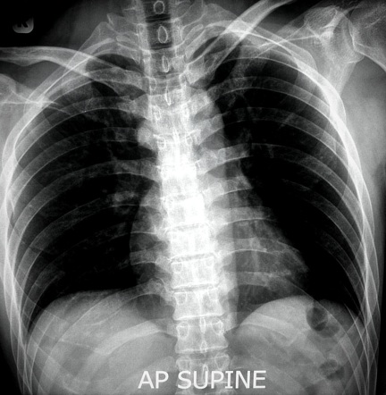 Pneumoperitoneum - the importance of projection | Radiology Case ...