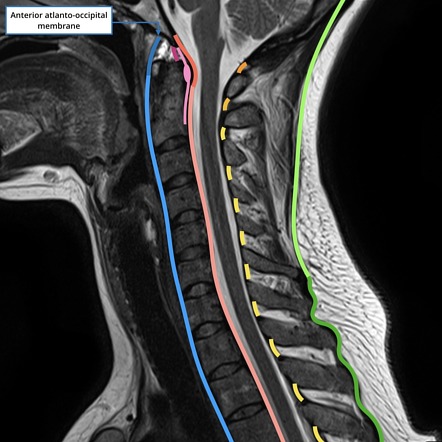 Anterior atlanto-occipital membrane | Radiology Reference Article ...