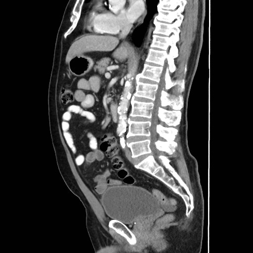 Cecal mass causing appendicitis | Image | Radiopaedia.org