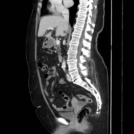 Splenic flexure cancer with omental caking | Image | Radiopaedia.org