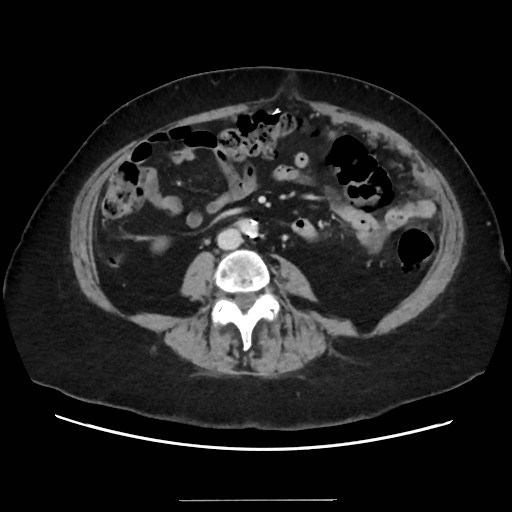 Splenic flexure cancer with omental caking | Image | Radiopaedia.org