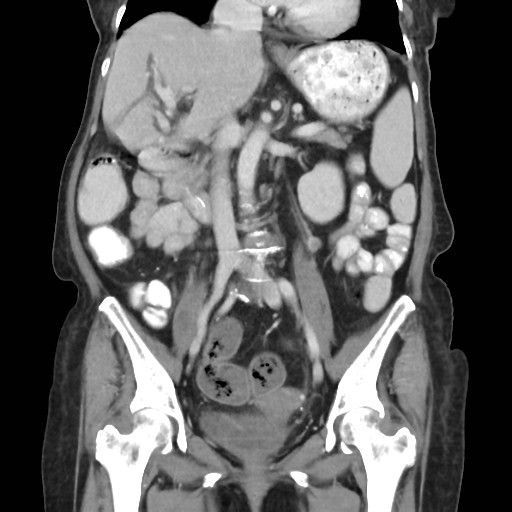 Transverse colon cancer and gastric GIST | Image | Radiopaedia.org