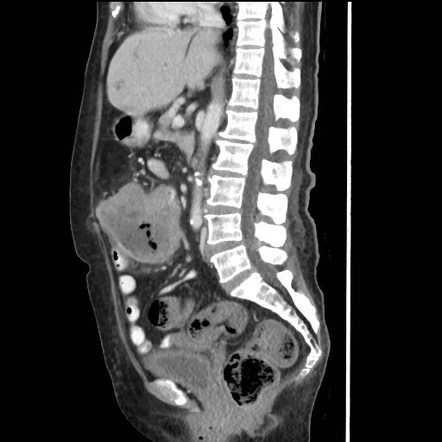 Transverse colon cancer and gastric GIST | Image | Radiopaedia.org