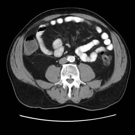 Cecal mass causing appendicitis | Radiology Case | Radiopaedia.org