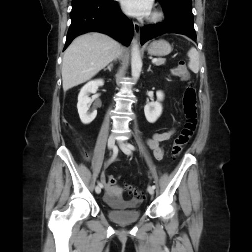 Splenic Flexure Cancer With Omental Caking Image 8953