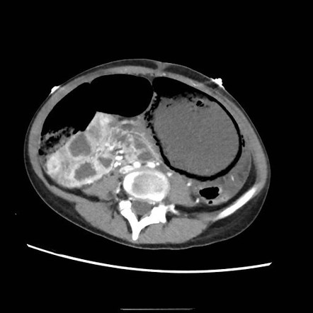 Gastric ischaemia from over-eating | Radiology Case | Radiopaedia.org