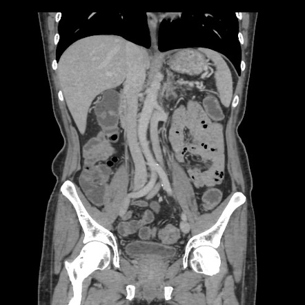 Duplication of inferior vena cava | Radiology Case | Radiopaedia.org