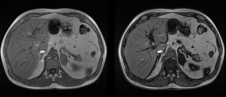 In-phase and out-of-phase sequences | Radiology Reference Article ...